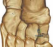 فتح الوتد العظمي تدريجياً للوصول إلى المحاذاة المطلوبة لمقدمة القدم