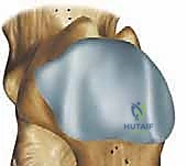 صورة توضيحية لـ جراحة كوتون (Plantarflexion Osteotomy): حل متقدم لتشوه القدم المسطحة في صنعاء مع الأستاذ الدكتور محمد هطيف