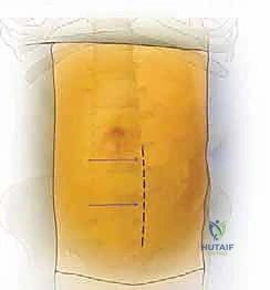 تطبيق العلاجات التحفظية قبل اللجوء للجراحة