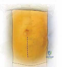 النهج الأمامي للعمود الفقري القطني: علاج متقدم لآلام الظهر المزمنة في صنعاء