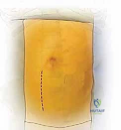 صورة توضيحية لـ النهج الأمامي للعمود الفقري القطني: علاج متقدم لآلام الظهر المزمنة في صنعاء