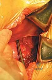 التثبيت النهائي باستخدام الشرائح والمسامير