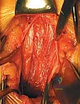 عمل الشق الجراحي في أسفل البطن