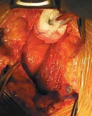 استئصال القرص الغضروفي التالف بدقة