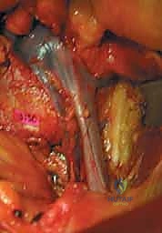 مرحلة التعافي وبدء العلاج الطبيعي