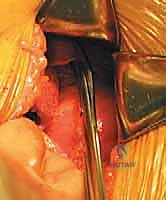 صورة توضيحية لـ النهج الأمامي للعمود الفقري القطني: علاج متقدم لآلام الظهر المزمنة في صنعاء