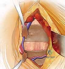 Anterior Lumbar Approach