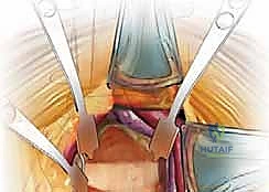 صورة توضيحية لـ النهج الأمامي للعمود الفقري القطني: علاج متقدم لآلام الظهر المزمنة في صنعاء