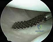 صورة توضيحية لـ إصلاح عدم استقرار الكتف متعدد الاتجاهات بالمنظار: خبرة الأستاذ الدكتور محمد هطيف في شد المحفظة المفصلية