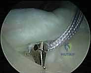 صورة توضيحية لـ إصلاح عدم استقرار الكتف متعدد الاتجاهات بالمنظار: خبرة الأستاذ الدكتور محمد هطيف في شد المحفظة المفصلية