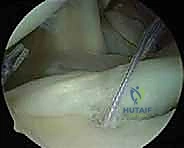 صورة توضيحية لـ إصلاح عدم استقرار الكتف متعدد الاتجاهات بالمنظار: خبرة الأستاذ الدكتور محمد هطيف في شد المحفظة المفصلية