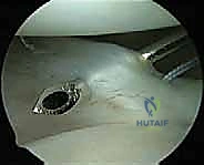 إصلاح عدم استقرار الكتف متعدد الاتجاهات بالمنظار: خبرة الأستاذ الدكتور محمد هطيف في شد المحفظة المفصلية