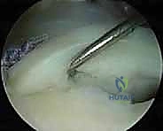 أعراض عدم استقرار الكتف والانزلاق المتكرر