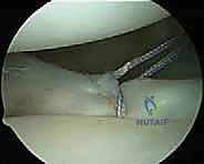 صورة توضيحية لـ إصلاح عدم استقرار الكتف متعدد الاتجاهات بالمنظار: خبرة الأستاذ الدكتور محمد هطيف في شد المحفظة المفصلية