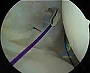 صورة توضيحية لـ إصلاح عدم استقرار الكتف متعدد الاتجاهات بالمنظار: خبرة الأستاذ الدكتور محمد هطيف في شد المحفظة المفصلية