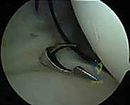 التصوير بالرنين المغناطيسي لتشخيص MDI