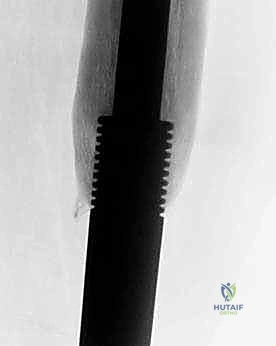 صورة طبية: إنقاذ الأطراف للأطفال زراعة الأطراف الاصطناعية القابلة للتمدد