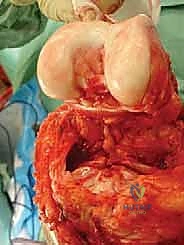 صورة توضيحية لـ إنقاذ الأطراف للأطفال زراعة الأطراف الاصطناعية القابلة للتمدد