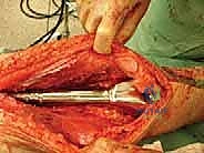 صورة توضيحية لـ إنقاذ الأطراف للأطفال زراعة الأطراف الاصطناعية القابلة للتمدد