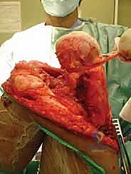 صورة طبية: إنقاذ الأطراف للأطفال زراعة الأطراف الاصطناعية القابلة للتمدد