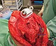 تقييم صفيحة النمو المتأثرة