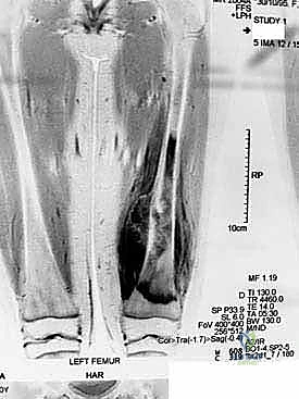 صورة توضيحية لـ إنقاذ الأطراف للأطفال زراعة الأطراف الاصطناعية القابلة للتمدد