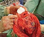 صورة توضيحية لـ إنقاذ الأطراف للأطفال زراعة الأطراف الاصطناعية القابلة للتمدد