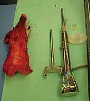 صورة توضيحية لـ إنقاذ الأطراف للأطفال زراعة الأطراف الاصطناعية القابلة للتمدد