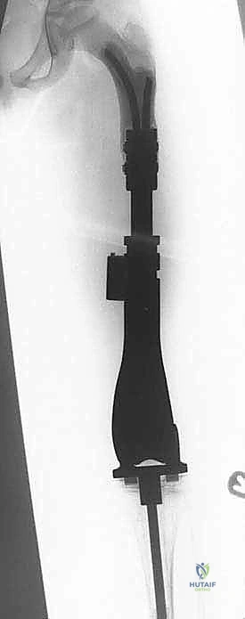 Illustration of risk of infection - Dr. Mohammed Hutaif