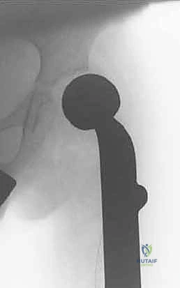 صورة طبية: إنقاذ الأطراف للأطفال زراعة الأطراف الاصطناعية القابلة للتمدد