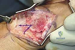 القص العظمي الممتد باستخدام منشار جراحي دقيق