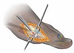 صورة توضيحية لـ جراحة شفرون البعيدة الممتدة: حل ثوري لتصحيح ورم إبهام القدم الأروح المعقد مع الأستاذ الدكتور محمد هطيف