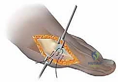 صورة توضيحية لـ جراحة شفرون البعيدة الممتدة: حل ثوري لتصحيح ورم إبهام القدم الأروح المعقد مع الأستاذ الدكتور محمد هطيف