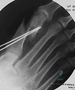 التخطيط الجراحي الدقيق قبل العملية