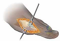 جراحة شفرون البعيدة الممتدة: حل ثوري لتصحيح ورم إبهام القدم الأروح المعقد مع الأستاذ الدكتور محمد هطيف