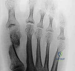 تثبيت العظام باستخدام مسامير التيتانيوم