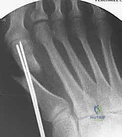 إزاحة العظم المشطي لتصحيح التشوه