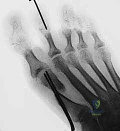 الوضع النهائي لمسامير التثبيت