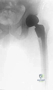 الأشعة السينية لمفصل الورك