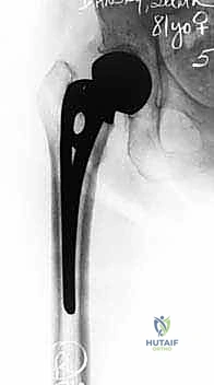 صورة توضيحية لـ رأب نصف مفصل الورك لكسور عنق الفخذ: دليل شامل لاستعادة الحركة مع الأستاذ الدكتور محمد هطيف في صنعاء