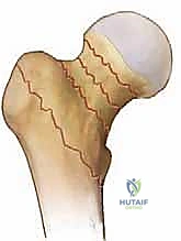 تخطيط هندسي لعظمة الفخذ