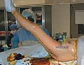 مريض يعاني من أعراض الكسر