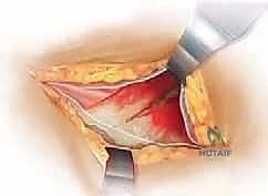 صورة توضيحية لـ رأب نصف مفصل الورك لكسور عنق الفخذ