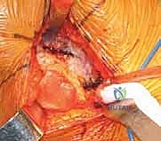 مكونات نصف المفصل الصناعي