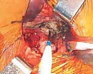 صورة طبية: رأب نصف مفصل الورك لكسور عنق الفخذ: دليل شامل لاستعادة الحركة مع الأستاذ الدكتور محمد هطيف في صنعاء