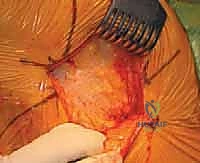 الأسمنت العظمي والتثبيت