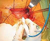 تفاصيل تشريحية لكسر عنق الفخذ