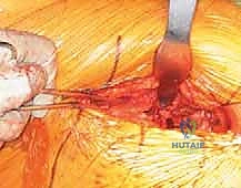 تروية دموية لرأس الفخذ