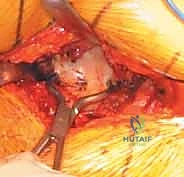 مراحل تطور النخر اللاوعائي