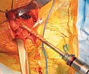 توضيح لآلية كسر الورك